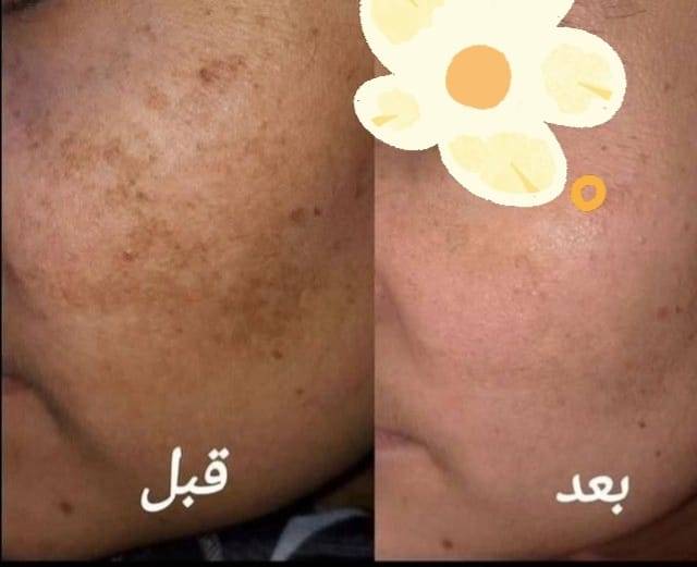 كورس تبييض • بديل الجلسات • بغداد