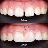 إغلاق الفراغ الأمامي • تجميل الأسنان • قضاء البدير