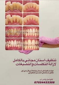 تنظيف اسنان مجاني • ازالة التكلسات • كلية طب اسنان ذي قار
