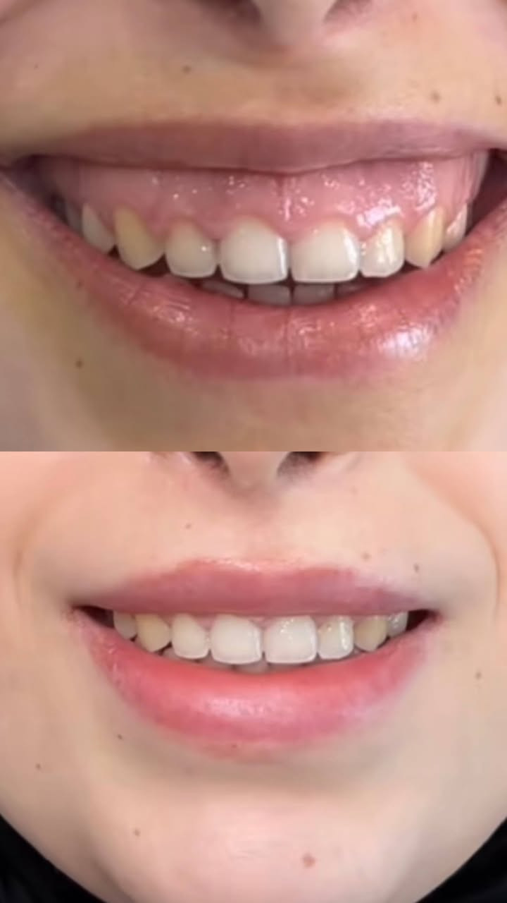قسم التجميل 💉
السلام عليكم
على بركه اللّٰه
نعلن عن افتتاح قسم التجميل بعياداتنه الكائنه في( حي النداء شارع ٦٠)
العرض الاول للبوتوكس فقط ب85الف بدل 125
لأول5 مراجعين فقط يحصلون على جلسة البوتوكس شد الجبهة ورفع وسحبة الحاجب والتجاعيد حول العين
بوتوكس ابتسامه لثويه فقط ٥٠
بوتوكس تصغير فتحات الانف فقط ٥٠
بوتوكس صرير الاسنان ٥٠ الف فقط
بوتوكس التعرق ١٠٠ فقط
عرض الفلر لل1cc فقط 80الف بدل 100 الف الفحص والاستشاره
مجاناً
التغيير الشامل  للرجال والنساء لكل الوجه وجنات ذقن اصداغ  شفه 500 بدل 900 مع جلسه تنظيف اسنان وبلازما مجاناً
ابره الخلايا الجذعيه لتوقف تساقط الشعر وأنبات الشعر الجديد  75
يوجد أبر نضاره ومحفزات كولاجين وميزوات تفتيح وازاله
التصبغات
عليهن عروض حلوه لفتره محدوده
علما جميع المواد امنه
ومفحوصه ومسجله بوزاره الصحه
للأستفسار والحجز على الارقام الاتيه
***********
***********
