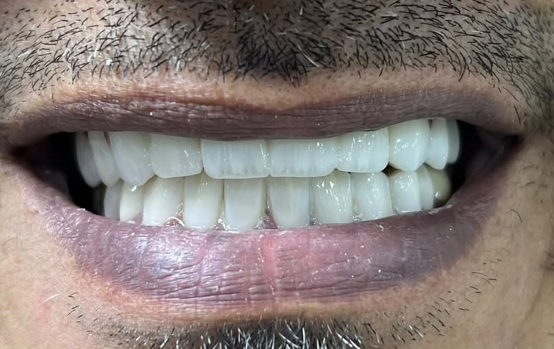 قبل تركيب ابتسامه ايماكس
واثناء العمل
وبعد تركيب الابتسامه
باشرف الطبيب ثائر عباس

📍 متواجدين يومياً طوال أيام الأسبوع:

⏰ من 9 الصبح إلى 12 الظهر
⏰ ومن 2:30 العصر إلى 9:30 بالليل

📞 للتواصل ويانه:

✅ العيادات البشرية: ***********
✅ عيادات التجميل: ***********
✅ عيادات الأسنان: ***********

📍 العنوان:
الناصرية – شارع بغداد، مجاور مدرسة الجواهري الأهلية

#العراق #تجميل #اكسبلور #ترند #explore
