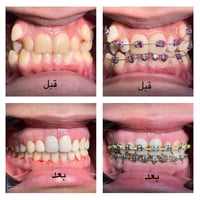 رفع التقويم بعد ترتيب وتعديل الاسنان للفكين مع قلع اربعة اسنان ضواحك  ...