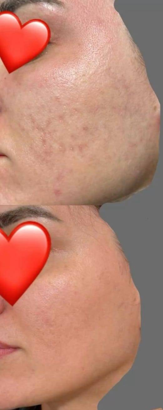 كورس تبييض • بديل الجلسات • بغداد