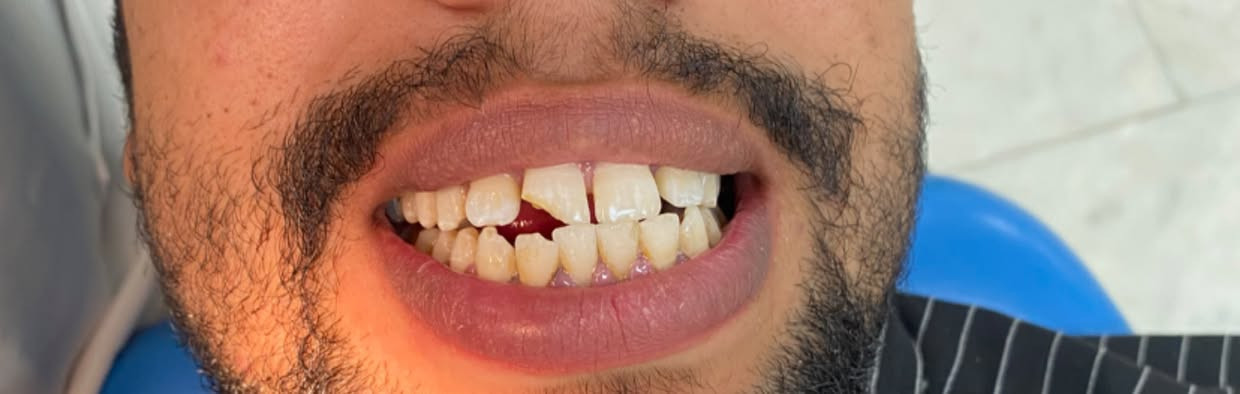 تنظيف أسنان • حشوات ضوئية • أطقم جزئية مجانية