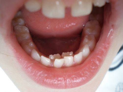 علاج أسنان أطفال • مجاني • كلية طب الأسنان