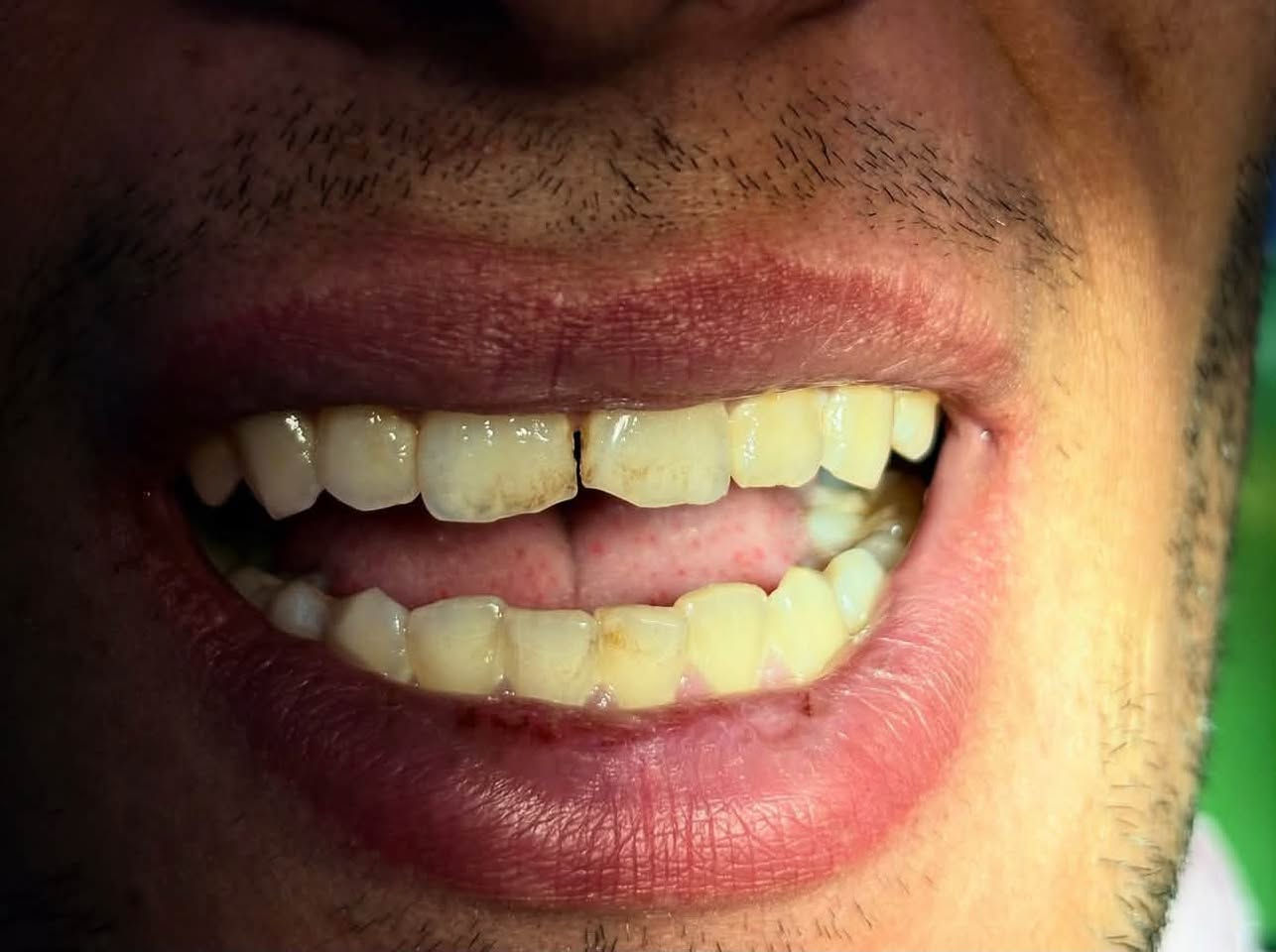 يتوفر معاينة و علاج اسنان مجاني بالكامل
حشوات عادية 
حشوات جذور 
تنضيف اسنان
قلع 
تعويض الاسنان بالجسور او الاطقم 
معاينة ومعالجة اسنان الاطفال 
العنوان الكرادة ساحة الواثق شارع ٥٢ 
لحجز موعد 
***********

نص مكتوب في الصور:
- 2/8
- BEFORE
- 1/8 BEFORE
- 1/5 BEFORE
- 2/3
- 2/7