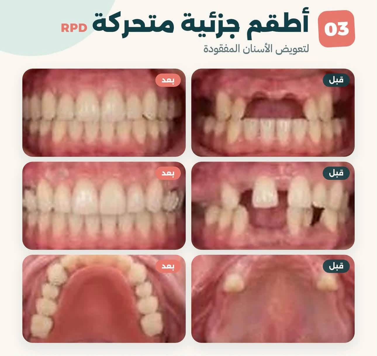 الكرادة جامعة اوروك • علاج مجاني • تنظيف الأسنان
