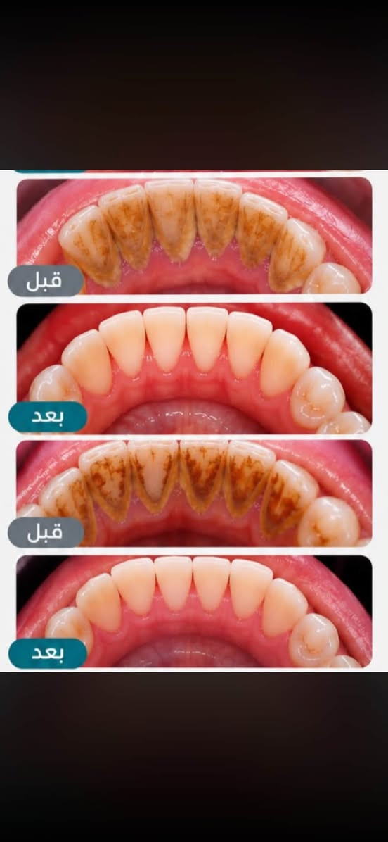 علاج مجاني • تنظيف أسنان • قبل وبعد