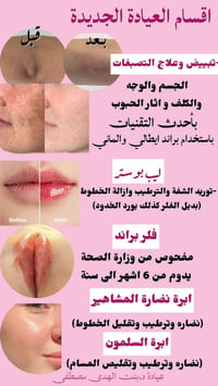 ليب بوستر • تبييض وتصبغات • الكريعات
