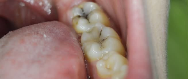 🦷 علاج أسنان مجاناً! 🤍

عندك سن يحتاج قلع؟ حشوة ضوئية؟ تنظيف تكلسات؟
أو عندك أسنان مفقودة وتحتاج طقم جزئي؟ 🦷✨

📍 العلاج في جامعة الفراهيدي – القادسية
👩🏻‍⚕️ تحت إشراف دكاترة وبشكل آمن.

✨ الخدمات:
▫️ قلع
▫️ حشوات ضوئية
▫️ تنظيف تكلسات
▫️ أطقم جزئية للأسنان المفقودة

📩 العدد محدود، واللي مهتم يراسلني خاص حتى نشوف الحالة ونحدد إذا مناسبة للعلاج.
او التواصل على الرقم ***********
🤍 لا تأجل علاج أسنانك… خلي ابتسامتك ترجع مثل قبل!
