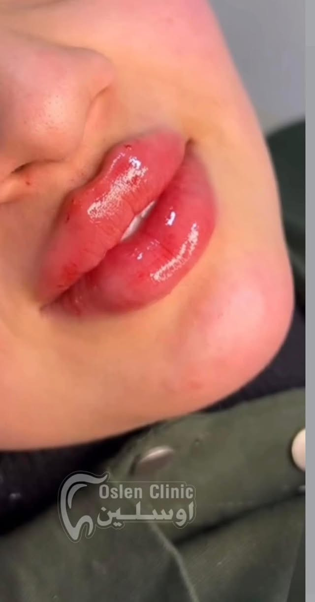 اوسلين كلينك للتواصل ***********  واتساب☎️
هلو بنات 💉حبيت اشاركم  تجربتي🦷  في افتتاح مركز اوسلين clinic في سبع بكار مقابل جوهره لبنان الجديده مجاور ❤️بيت العنكوبت مع ❤️عروض تجنن  ❤️امركز اوسلين لطب وتجميل الاسنان وتجميل لا جراحي. فلر بوتوكس ❤️ابتسامه اسنان حشوات بنات شغل الدكتورات يجنن قسم بالله❤️ 
للتواصل ارقامهم ***********  ☎️واتساب صفحه 
انستا عيادة أوسلين لطب  وتجميل الاسنان https://www.instagram.com/oslen.clini?igsh=ZnNwbHM1b2UyNHZp
