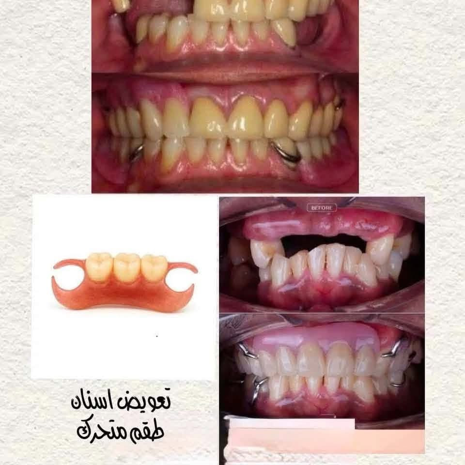 السلام عليكم...
نستقبل الحالات التالية في عيادات طب الأسنان

• تنظيف الأسنان من التصبغات و التكلسات

• حشوات تجميلية (ضوئية)

• قلع الأسنان و الجذور التالفة

 •تعويض الأسنان بالطقم الجزئي

العنوان : بغداد - الدورة-شارع 60

علما أن العلاج مجاني وتحت إشراف أطباء اختصاص.

للحجز والأستفسار:

***********

نص مكتوب في الصور:
- قلع الأسنان والجذور التالفة
- تنظيف وازالة التصبغات
- BEFORE
- تعويض اسنان
- طقم متحرك
- علاج تسوس الاسنان بحشوات تجميلة
