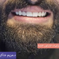 تركيبات زاركون • ابتسامة مشرقة • حي الفارس