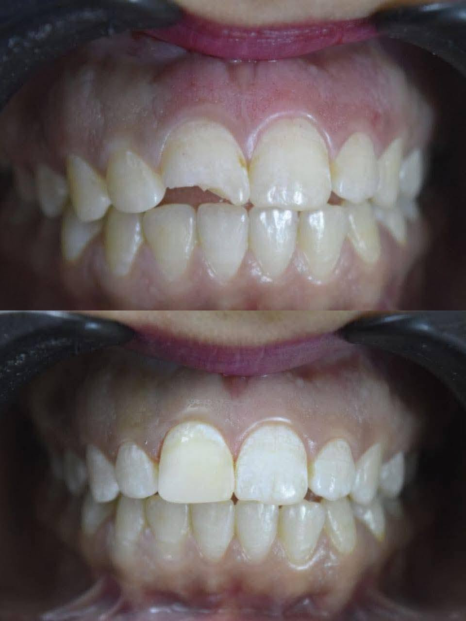 عروض الاسنان يمنه غير والي من طرفي اله خصم خاص من العياده
عيادة ألبيت ألطبي 
🦷 تنظيف وتلميع الأسنان
بدل 25 ألف
صار فقط ٢٠ ألف ✨

🦷 الحشوات الضوئية الدائمية
بدل 50 ألف
صار فقط 30 ألف 😍

🦷 تركيبات الزركون الثابتة
بدل 125 ألف
صار فقط 85 ألف 💎

🦷 تركيبات السيراميك
بدل 100 ألف
صار فقط 70 ألف 🔥

والفحص والمعاينة مجاني
✅ أفضل المواد والأجهزة الحديثة
✅ شغل تجميلي طبيعي ومضمون
✅ أسعار وعروض لفترة محدودة
✅ ابتسامة مرتبة بأقل تكلفة
📍 المحمودية – حي الموظفين – مقابل التانكي
🦷 بكج تنظيف + تلميع + تبييض الأسنان 🤍
تخلّص من التصبغات وتراكمات الأسنان، واسترجع نظافة ولمعان ابتسامتك 
🔥 بكج متكامل بسعر مميز ولفترة محدودة!
✔️ إزالة التكلسات
✔️ تنظيف وتلميع الأسنان
✔️ تبييض الأسنان
✔️ ابتسامة أنظف وأجمل ✨
📍 عيادة البيت الطبي
📞 للحجز والاستفسار: ***********
📲 الحجز متوفر عبر الواتساب

لا تخلي ابتسامتك تنتظر… احجز موعدك الآن �
