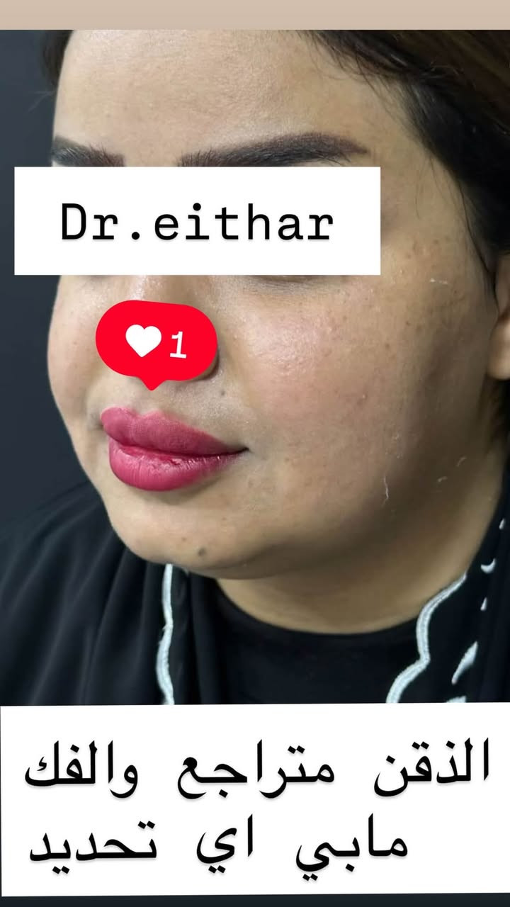 كونتور الوجه بالفلر  (لفتنك وجنات وتدوير الفك والذقن ونظاره) 🔥🔥
لاحضو الفرق بالذقن ومنطقه الفك شكد تغير الشكل🔥
عروووض فرحة الزهره ثبتتهه الكم بالستوري بالهايلايت وببوست اعلى الصفحة ✨✨

د.ايثار سامي عبد الامير
واسط الكوت الهوره مجمع القبطان طابق اول 

الحجز***********
