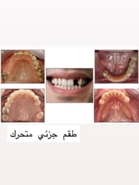 علاج مجاني • طقم جزئي متحرك • باجر العيادة