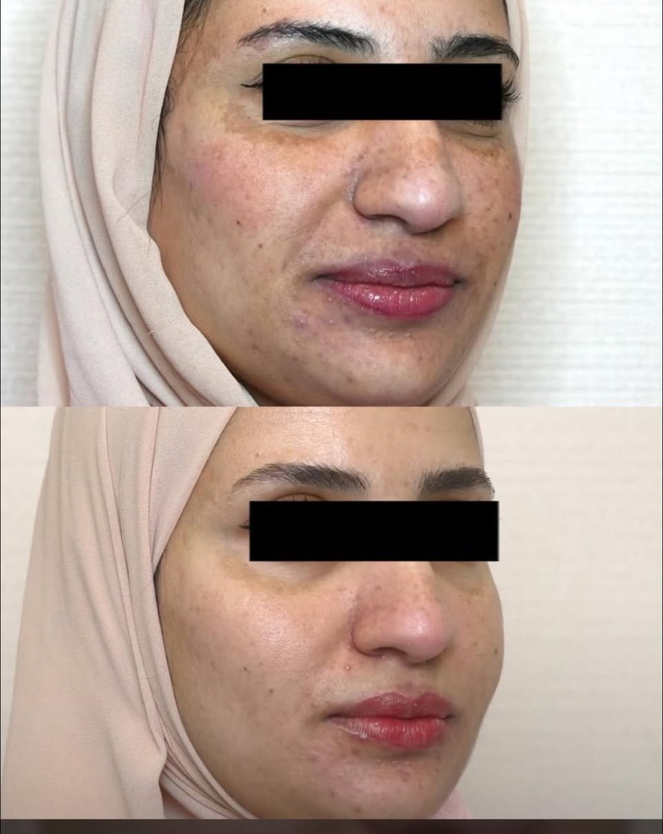 تركيبة ميلانين • تصبغات عميقة • مرطب ومغذي
