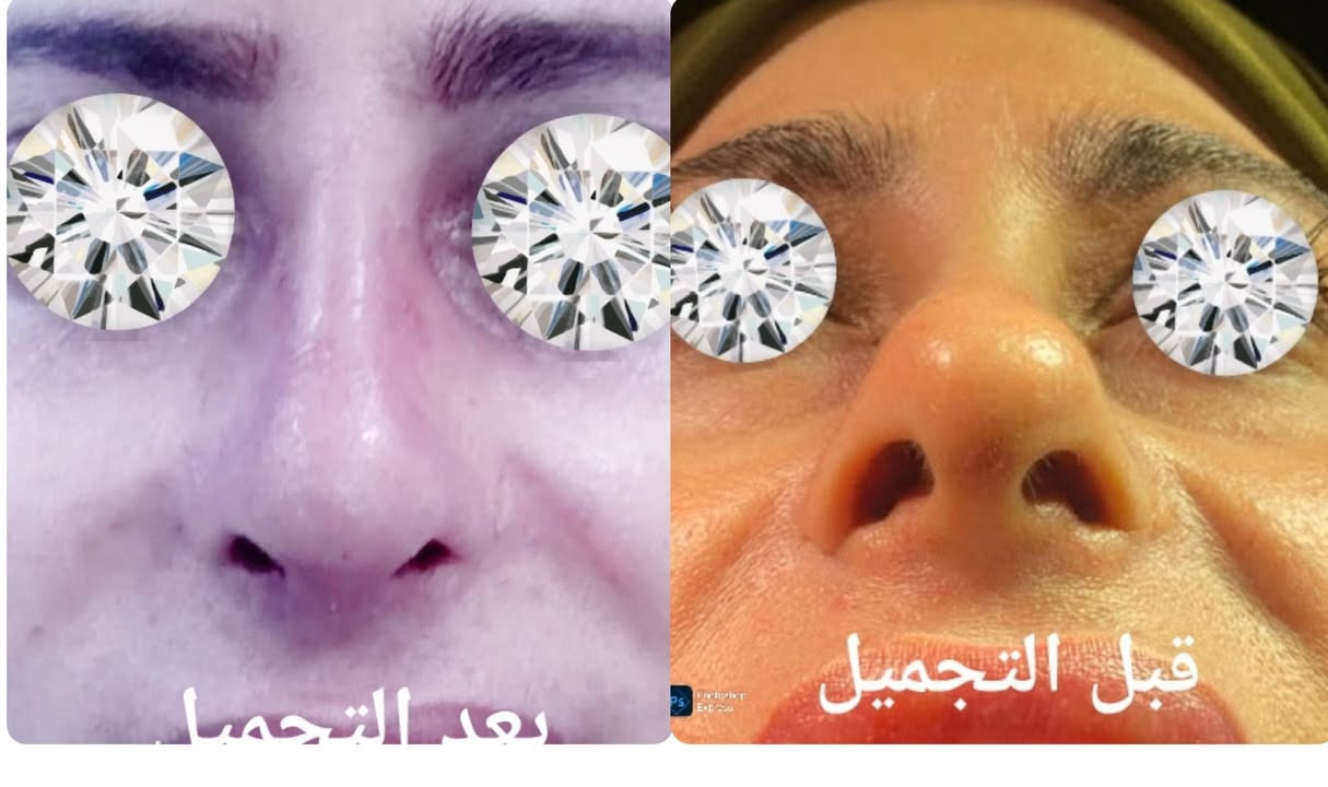 ترميم الأنف • تجميل أنف ثانوي • عيادة الياسيري