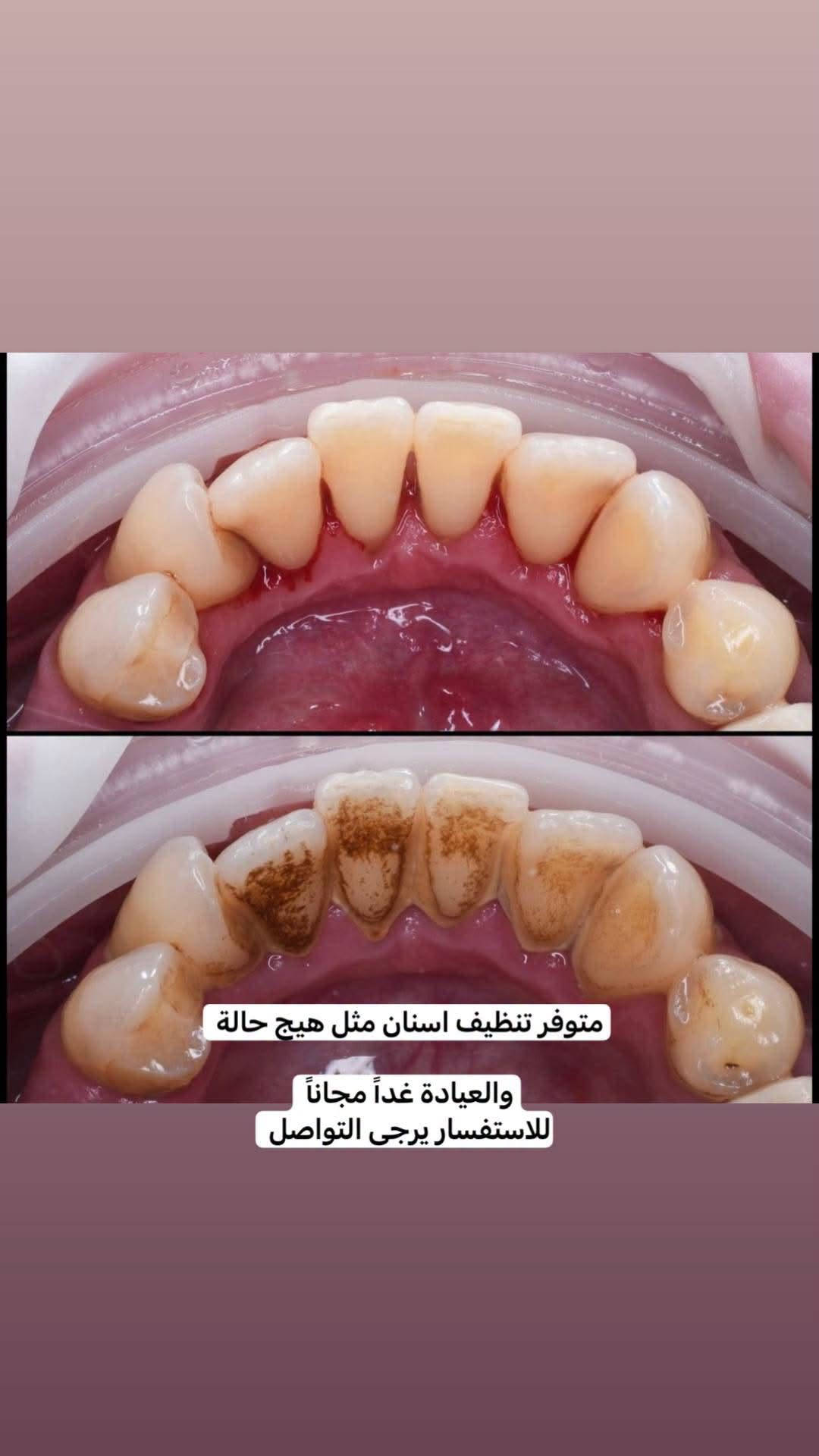 تنظيف أسنان • عيادة مجانية • للاستفسار