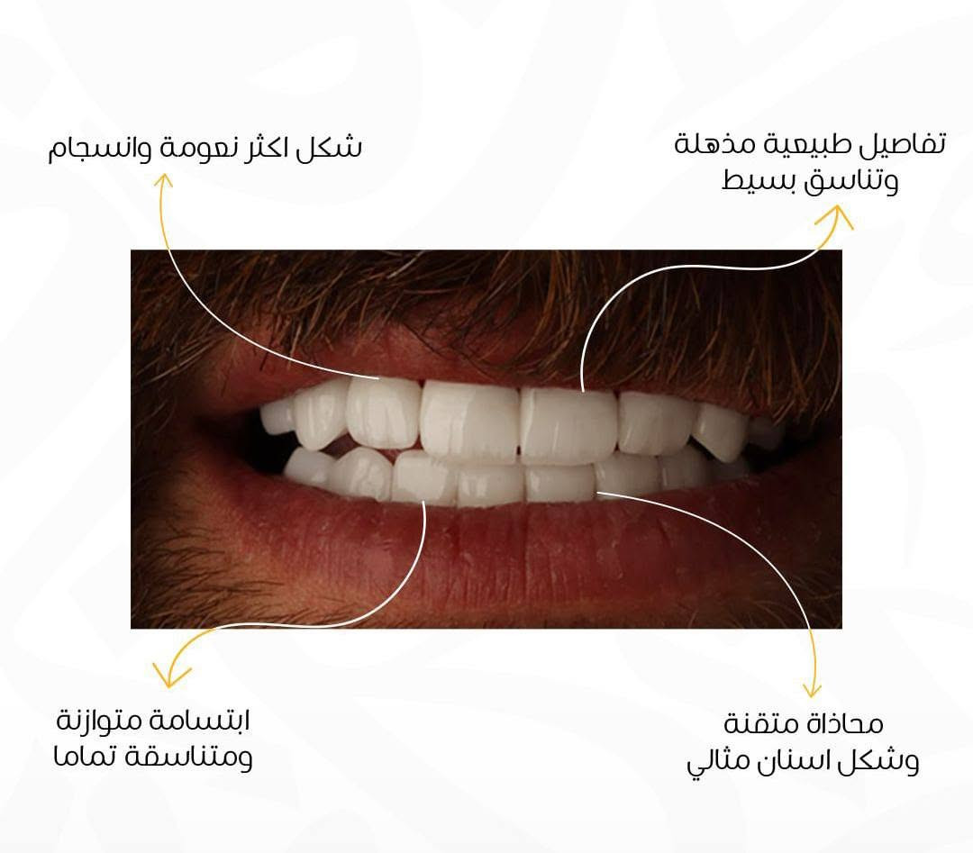 ترميم اللثة • ابتسامة طبيعية • تقسيط