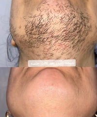 صالون الفراشات • نتيجة الليزر • واتساب