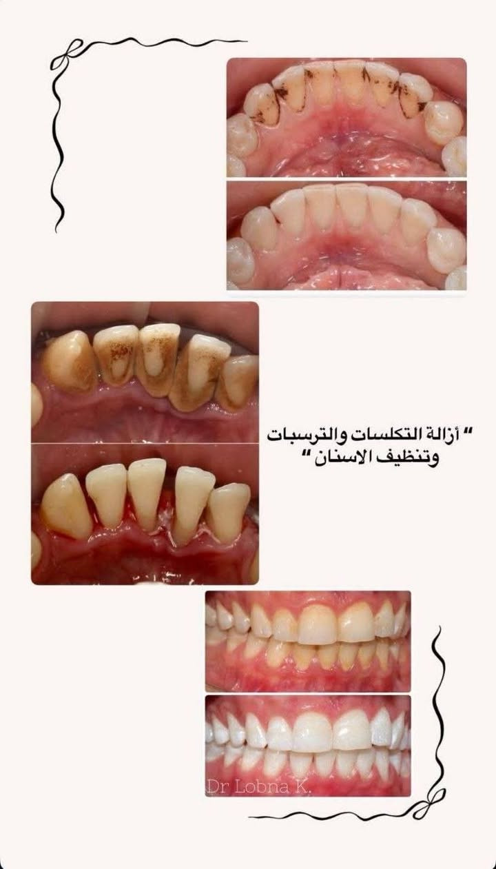 السلام عليكم الي محتاج:
قلع للأسنان التالفة و الجذور المتبقية
حشوات ضوئية وتجميلية
ننظيف الأسنان وازالة التكلسات والتصبغات
طقم اسنان جزئي
يتواصل وياي***********.... 

علماً ان العلاج مجاني وتحت إشراف اطباء اختصاص 

📍عيادات جامعه الحله /شارع 40 مجاور صيدلية سلامتك أولاً

نص مكتوب في الصور:
- هاي الحالات الي نستقبلها ب عيادات الجامعة 🦷 " الحشوات الضوئية والتجميلية أستقبل كل حالات التسوس الموضحة بالصور "
- أزالة التكلسات والترسبات وتنظيف الاسنان Dr Lobna K.