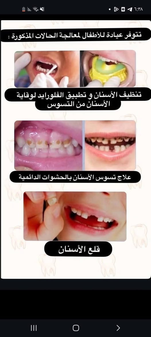 ​🦷 1_ حشوات الأسنان الدائمة الضوئية
🦷 2_ حشوات الجذور للأسنان الأمامية

​🦷 3_ تقويم أسنان متحرك

​🦷 4_ فحص وعلاج جميع حالات الأطفال

​🦷 5_ قلع الأسنان التالفة والجذور المتبقية

​🦷 6_ تنظيف الأسنان وإزالة التكلسات

​🦷 7_ تعويض الأسنان المفقودة بطقم متحرك كامل

​🦷 8_ تشخيص وعلاج الأمراض المتعلقة بالفم

​علماً العلاج مجاناً وتحت إشراف أطباء اختصاص

​📞 ***********

📍 بابل _ شارع 40 مجاور صيدلية سلامتك أولاً

​[ا

نص مكتوب في الصور:
- إذا عندكم ( طفل او بالغ ) هيج حالة تواصلوا وياي
- الحالات المطلوبة بتنظيف الأسنان هي التكلسات القويه مثل الي بالصور 👇🏻 قبل بعد
- تتوفر عيادة للأطفال لمعالجة الحالات المذكورة :
- تنظيف الأسنان و تطبيق الفلورايد لوقاية الأسنان من التسوس
- علاج تسوس الأسنان بالحشوات الدائمة
- قلع الأسنان
- اللي عنده هيج حالة ويريد يسوي أسنانه يتواصل ويايه اثبت اله حجز الاسبوع القادم ان شاء الله