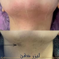 قبل وبعد • جلسة ليزر • ليزر ذقن