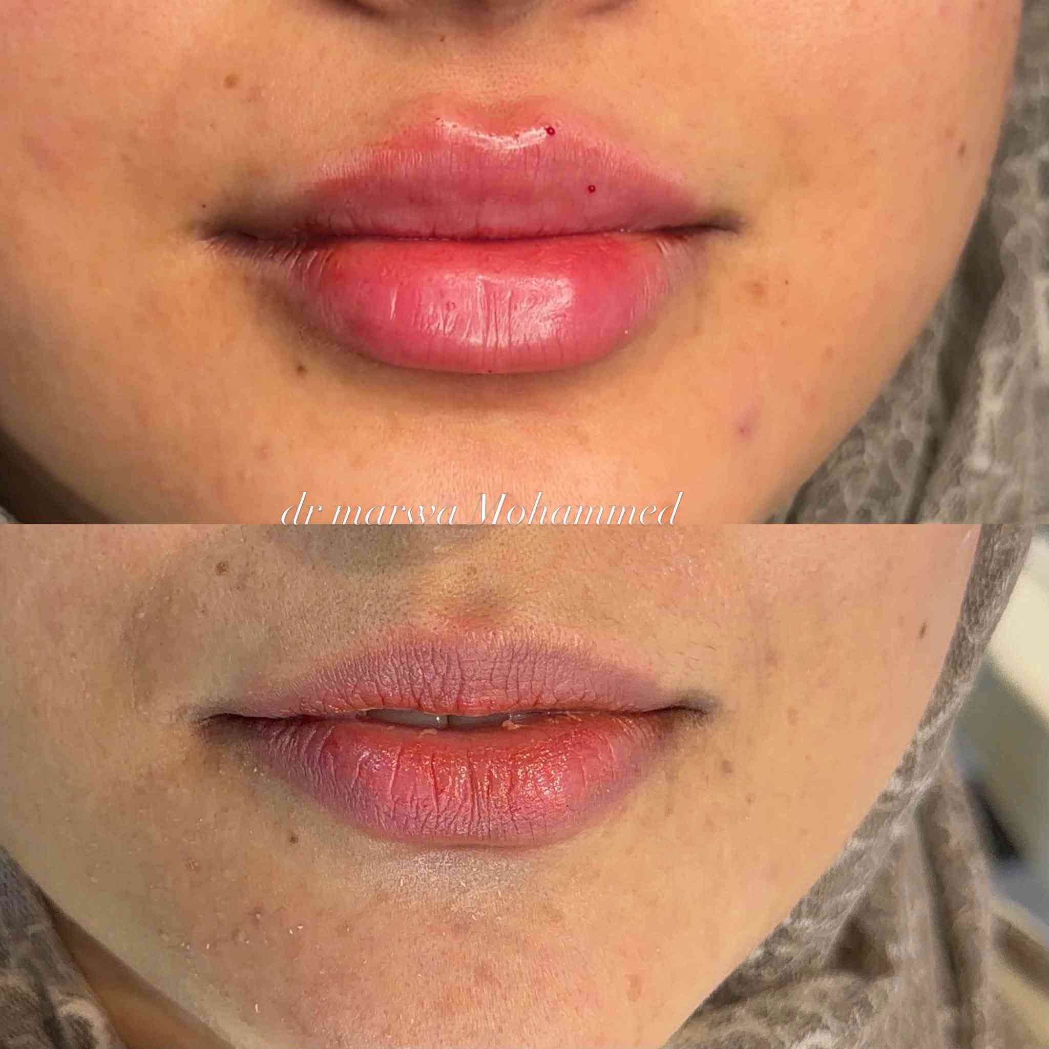 حقن فلر شفه وابرة السلمون للبشرة للجميلة ✨❤️

عيادة الدكتورة مروة محمد التميمي

🏥الديوانية العروبة-شارع المتحف-مجاور مطعم كودو كودو
📞رقم الحجز ***********

متوفر نظام التقسيط على الماستر كارد
