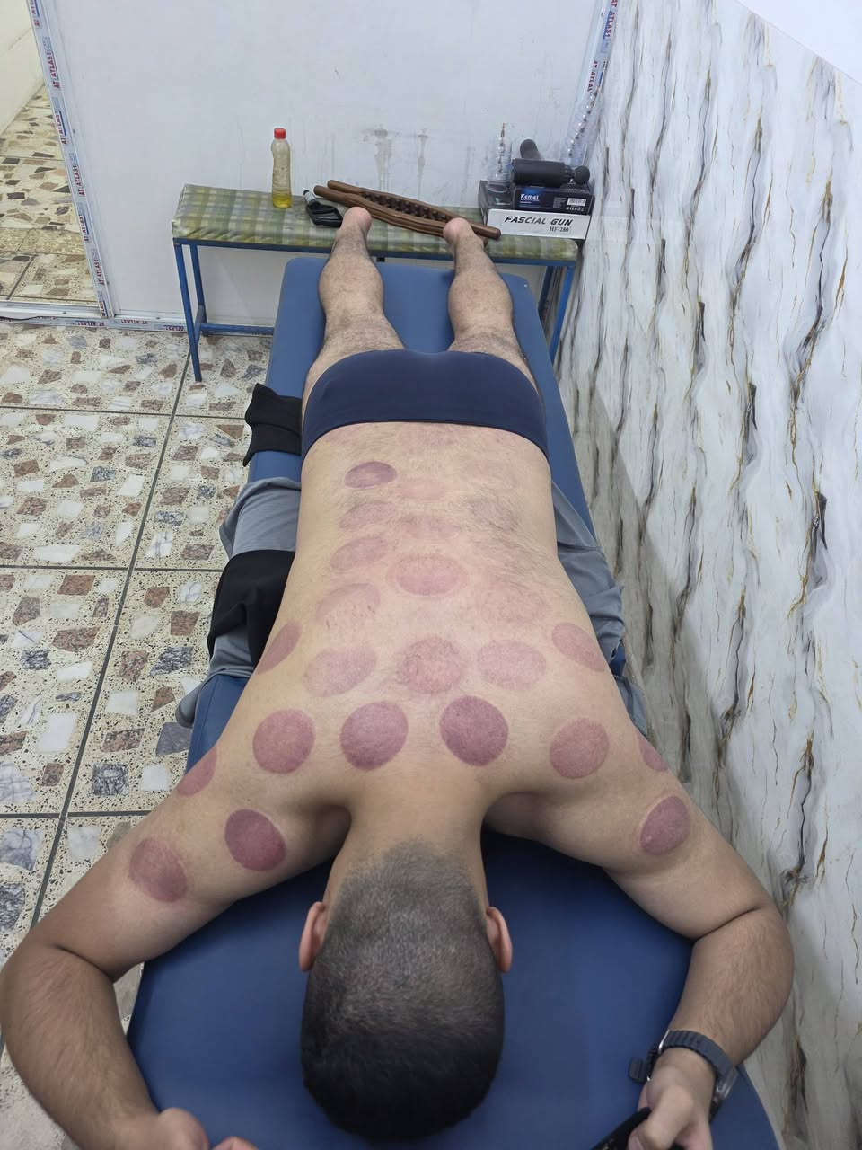 حجامة دموية • حجامة جافة • مساج