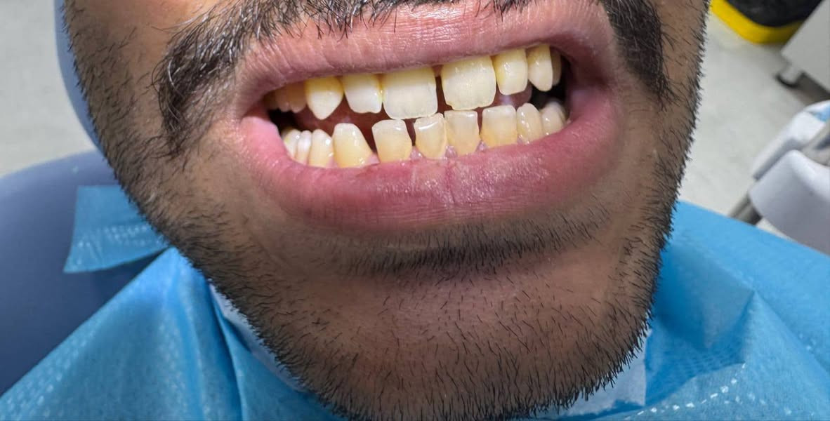 بسم الله الرحمن الرحيم
يعلن مستشفى جامعة البيان التعليمي فتح ابابه لاستقبال الحالات المرضية الخاصة بطب الاسنان التي تشمل :- 
اولا العلاج المجاني🟩🟩🟩 :-
1- قلع و ازالة الجذور التالفة و الاسنان المتداعية 
2- الحشوات الضوئية و حشوات الجذور
3- تنظيف الاسنان العميق 
4- اطقم متحركة كاملة و جزئية
5- تقويم الاسنان المتحرك
6- علاج الاطفال و الاسنان اللبنية بكافة حالاتها 
ثانيا العلاج المدفوع🟥🟥 :-
1-  عمليات جراحة اللثة الصغرى 
2 - زراعة الاسنان 
علما ان اغلب الحالات المذكورة في الاعلى يكون علاجها مجاني الا الزراعة و عمليات اللثة الصغرى تكون باسعار رمزية جدا
علما ان العلاج يكون تحت اشراف دكاترة مختصين 

للحجز و الاستفسار التواصل على الرقم :- ***********
