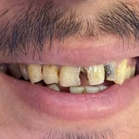 حشوات جذر • تغليف زيركون • اسبوع واحد