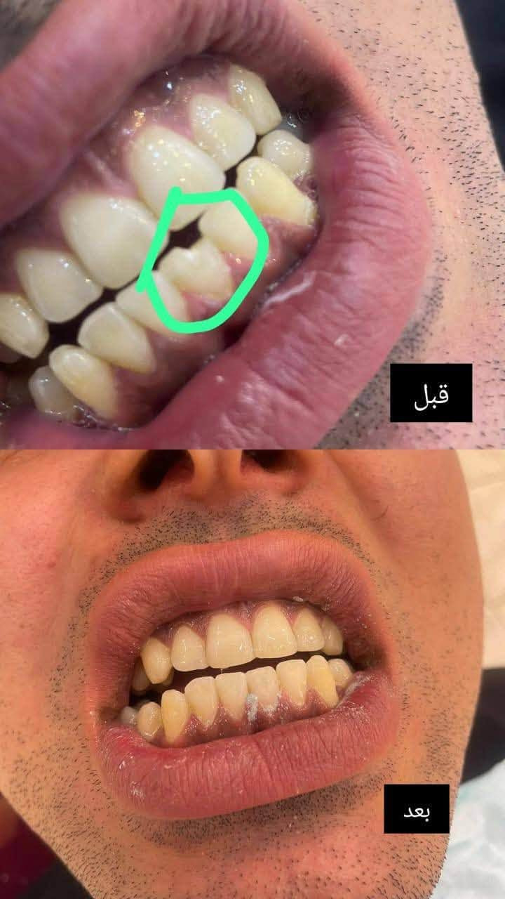 علاج أسنان مجاني • حشوات تجميلية • شارع فلسطين