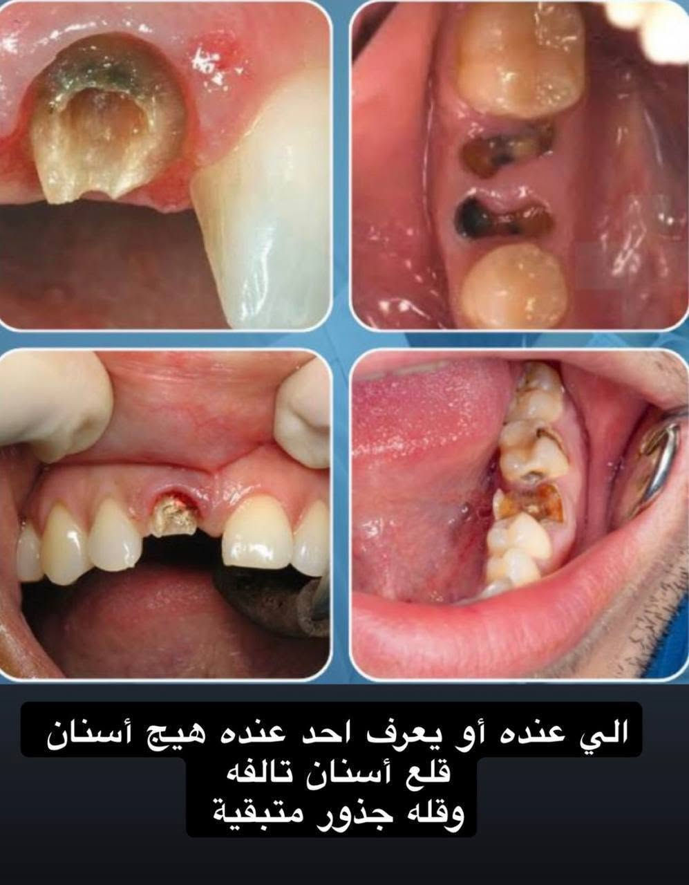علاج مجاني • تنظيف اسنان • تسوس جانبي