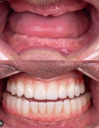 تعويض اسنان • علاج مجاني • عيادة ابن سينا
