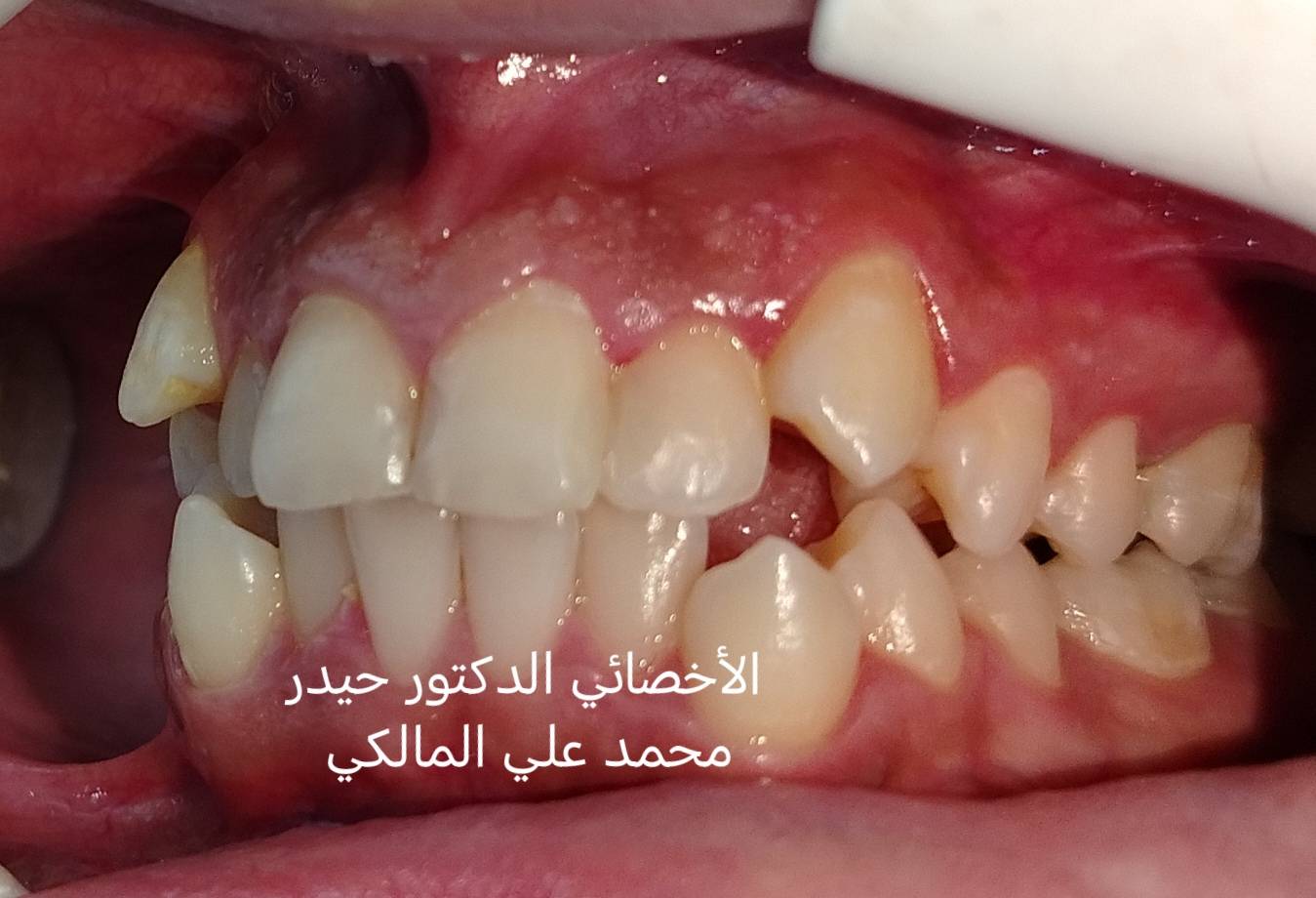 تقويم أسنان • بالتقسيط • شارع فلسطين