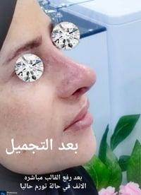 ترميم الأنف • تجميل أنف ثانوي • عيادة الياسيري