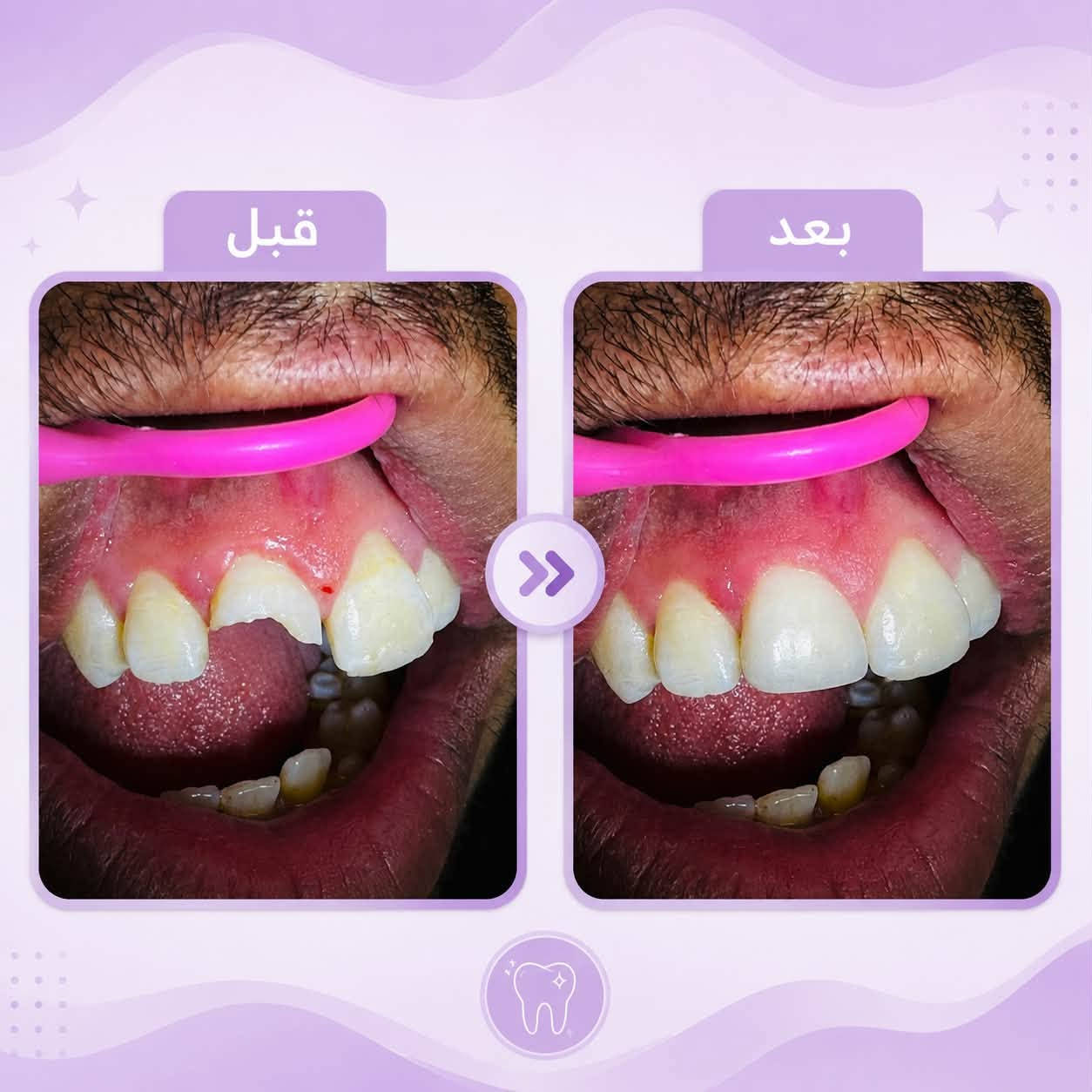 العلاج مجاناً • حشوات تجميلية • قلع جذور