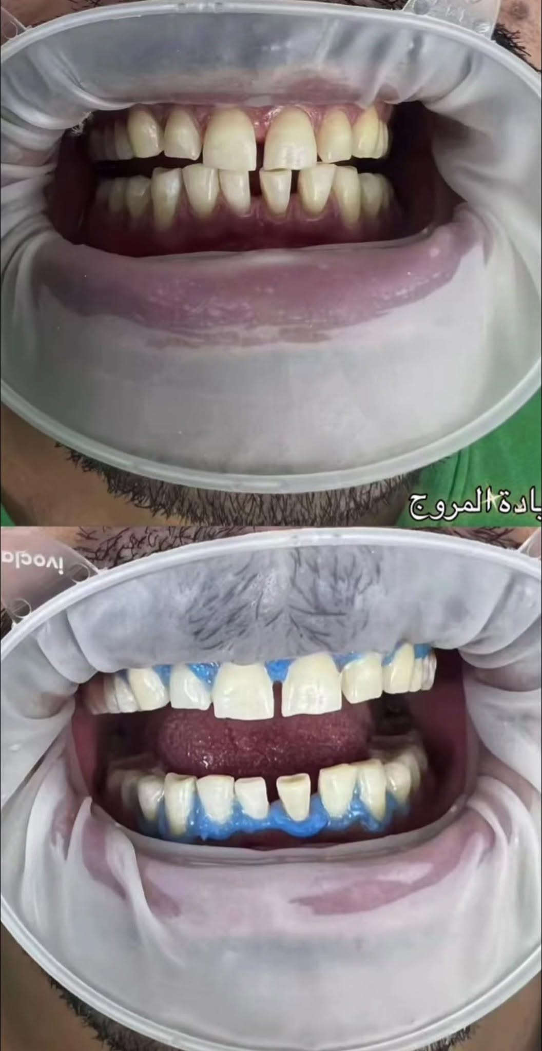 تبييض بالليزر • جلسة واحدة • عيادة المروج