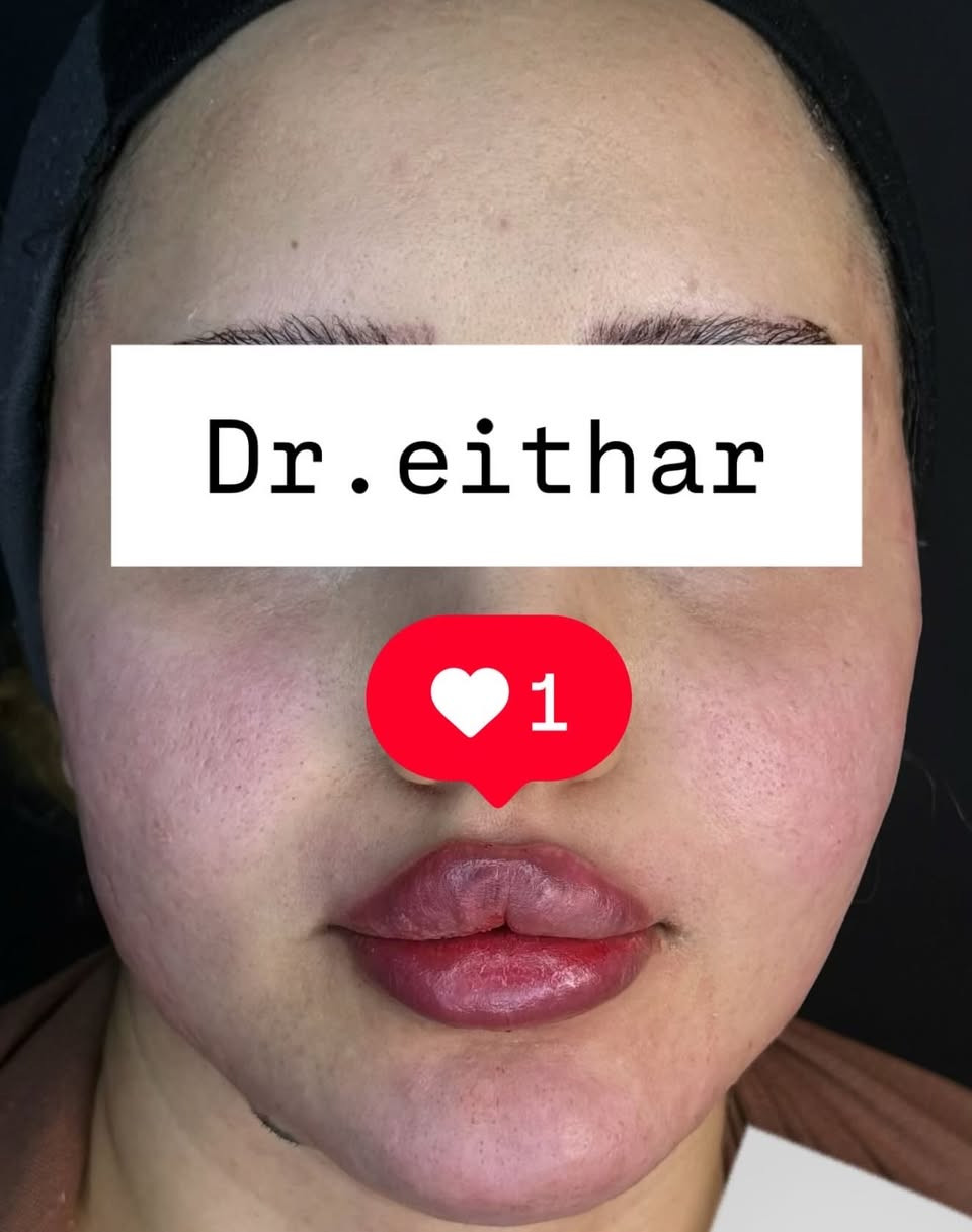كونتور الوجه بالفلر  (لفتنك وجنات  واصداغ وتدوير الفك والذقن ونظاره وشفة تعديل ع حقن سابق للشفة) 🔥🔥
لاحضو الفرق بالذقن ومنطقه الفك   شكد تغير الشكل🔥
عروووض للكادر التدريسي والخريجات والموظفات والعروسات  ثبتتهه الكم بالستوري بالهايلايت وببوست اعلى الصفحة ✨✨

د.ايثار سامي عبد الامير
واسط الكوت الهوره مجمع القبطان طابق اول 

الحجز***********

نص مكتوب في الصور:
- Dr.eithar 1