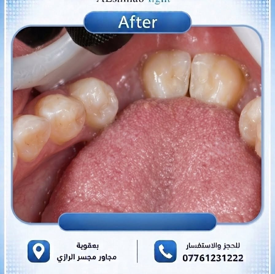 � من قرار القلع… إلى إنقاذ السن والحفاظ عليه!

راجعتنا المريضة وهي تعاني من ألم وعدم ارتياح في السن، وكانت قد قررت مسبقًا قلعه للتخلص من الألم.

بعد تقييم الحالة، تم توضيح إمكانية الحفاظ على السن وإعادة تأهيله بدلًا من فقدانه، وتم إقناع المريضة بمحاولة إنقاذه.

🔹 أُجريت معالجة لبّية (حشوة جذر) كاملة للسن بهدف التخلص من مصدر الألم والحفاظ عليه.
🔹 وبعد نجاح المعالجة، تم إعادة بناء السن بحشوات مدعّمة بالألياف (Fiber-reinforced) لزيادة دعمه وتقليل احتمالية تعرضه للكسر،  وتمت معالجة السن السادس ايضاً كان فيه تسوس في مراحلة البدايه والحفاظ عليه لأطول فترة ممكنة.

✨ الهدف دائمًا: إنقاذ السن الطبيعي متى ما كان ذلك ممكنًا، بدلًا من اللجوء إلى القلع.

#علاج_الجذور #حشوة_جذر #اعادة_بناء_السن #حشوات_الياف #الحفاظ_على_السن طب_الاسنان اسنان علاج_الاسنان دكتور_اسنان بعقوبة ديالى DentalCare RootCanalTreatment FiberReinforced

