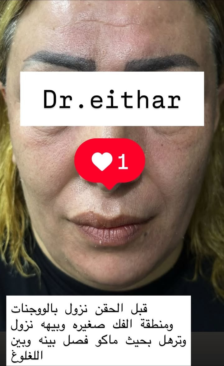 شد الوجه بالفلر والمحفزات  (لفتنك وجنات  واصداغ وتدوير الفك والذقن ونظاره وشفة فقط تعديل لان عدهه اختلاف بين الجهتين وبوتوكس  بعد اسبوعين من الحقن ) 🔥🔥🔥

اتمددت عروووض للكادر التدريسي والخريجات والموظفات والعروسات لنهايه الاسبوع ليوم الاربعاء اخر يوم  ثبتتهه الكم بالستوري بالهايلايت وببوست اعلى الصفحة ✨✨

د.ايثار سامي عبد الامير
واسط الكوت الهوره مجمع القبطان طابق اول 

الحجز***********

نص مكتوب في الصور:
- Dr.eithar 1 شد الوجه بالفلر والمحفزات(اصداغ ووجنات وتدوير الفك والذقن) وبوتوكس وشرفة فقط تعديل لان عده جهه بيه تليف نتيجة ضربة قديمه وعاليه
- Dr.eithar
- 1
- هنا النتيجة بعد اسبوعين بس
- شوفو التجاعيد بالكصه شون
- راحت وحول العين وانفتحت العين
- والحاجب انرفع
- Dr.eithar 1 لفتنك اصداغ وجنات وتدوير الفك والذقن بالفلر والمحفزات وبوتوكس وشفة فقط تعديل
- قبل الحقن نزول بالووجنات ومنطقة الفك صغيره وبيهاه نزول وترهل بحيث ماكو فصل بينه وبين اللغلوغ
- قبل الحقن