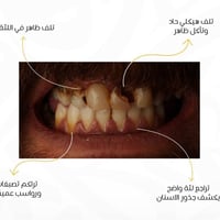 ترميم اللثة • ابتسامة طبيعية • تقسيط