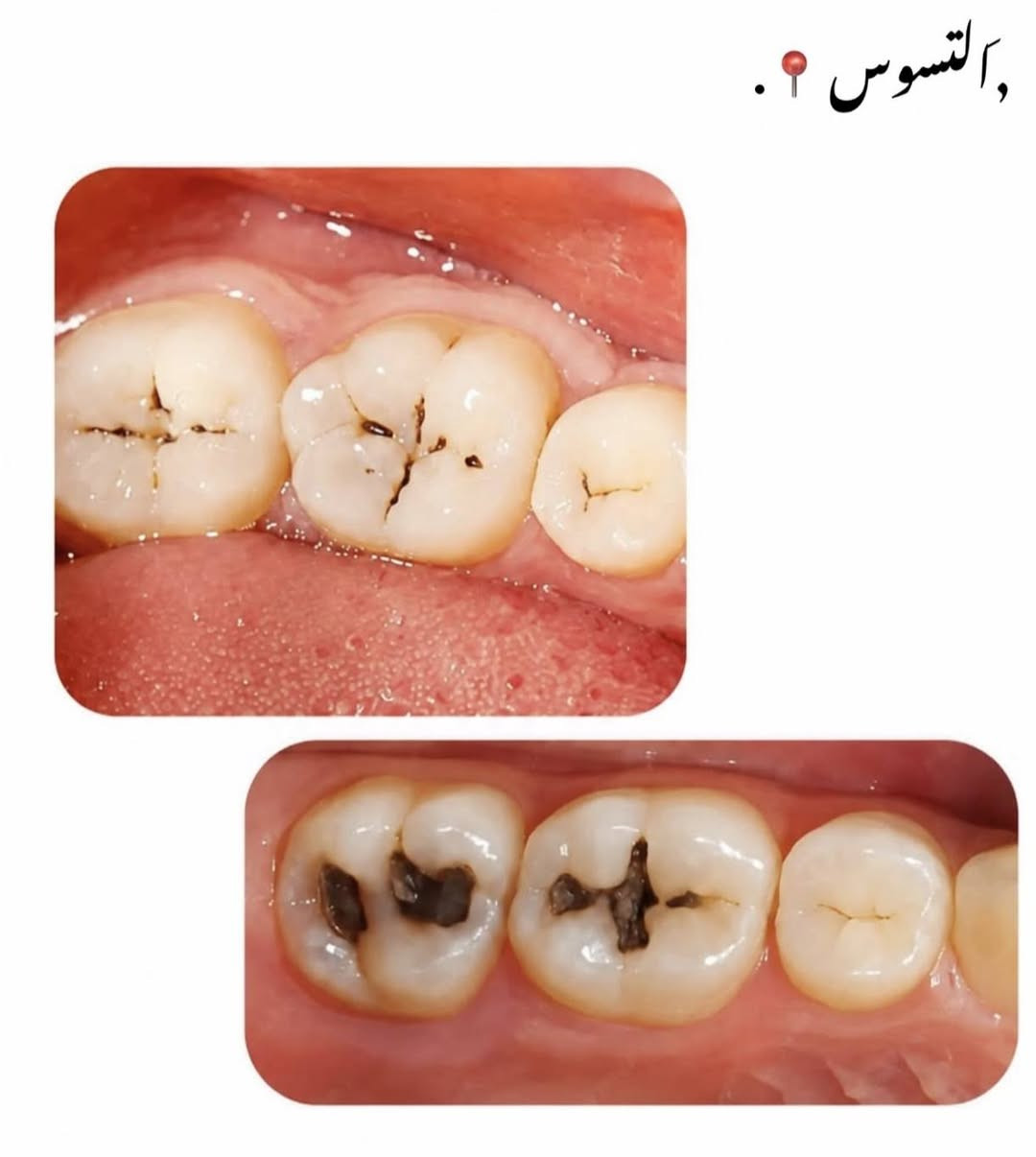 علاج مجاني بالكامل
السلام عليكم اي شخص عنده حالة من الحالات نكدر نعالج اسنانه بشكل مجاني بالكامل 
واتساب ***********

نص مكتوب في الصور:
- مجاناً
- التنظيف؟.
- التسوس 📍 .
- حالات اخرى .
- القلع 📍 .
