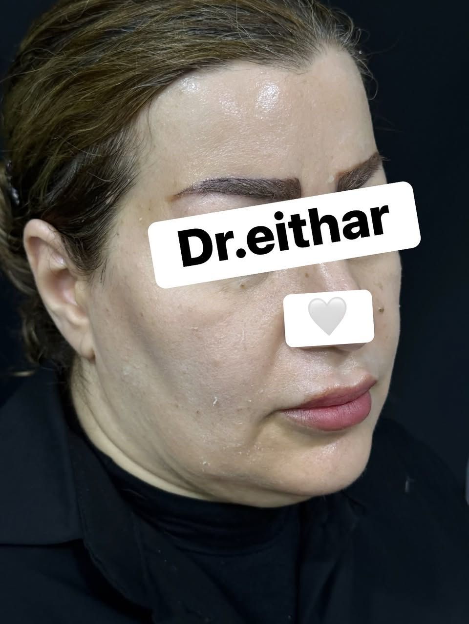 استداره الوجه كامله (لفتنك وجنات واصداغ وتدوير الفك والذقن ونظاره) 🔥🔥

عروووض فرحة الزهره ثبتتهه الكم بالستوري بالهايلايت وببوست اعلى الصفحة ✨✨

د.ايثار سامي عبد الامير
واسط الكوت الهوره مجمع القبطان طابق اول 

الحجز***********
