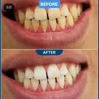 تنظيف اسنان • عرض مجاني • كربلاء الحر