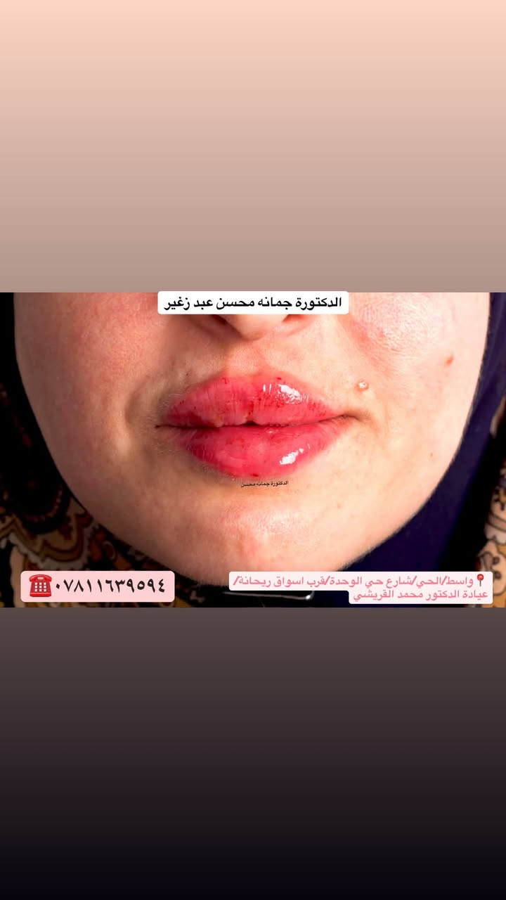 فلر الشفة مو مجرد امتلاء وانما نرسم الشفة بالفلر  بطريقة تبرز ملامحج وتزيدج انوثة وجمال لان انتي تستحقين الافضل دائما✨🩷

📍العنوان:عيادة الدكتور محمد حسن القريشي/واسط/الحي/شارع حي الوحدة قرب اسواق ريحانة

***********☎️

#explorar  #explorepage✨  #ترويج  #ترويج_صفحات_الفايسبوك_الإنستغرام   #واسط#

نص مكتوب في الصور:
- الدكتورة جمانه محسن عبد زغير
- الدكتورة جمانه محسن
- ***********
- واسلط/الحي/شارع حي الوحدة/قرب اسواق ريحانة/
- عيادة الدكتور محمد القريشي
- واسط/الحي/شارع حي الوحدة/قرب اسواق ريحانة/