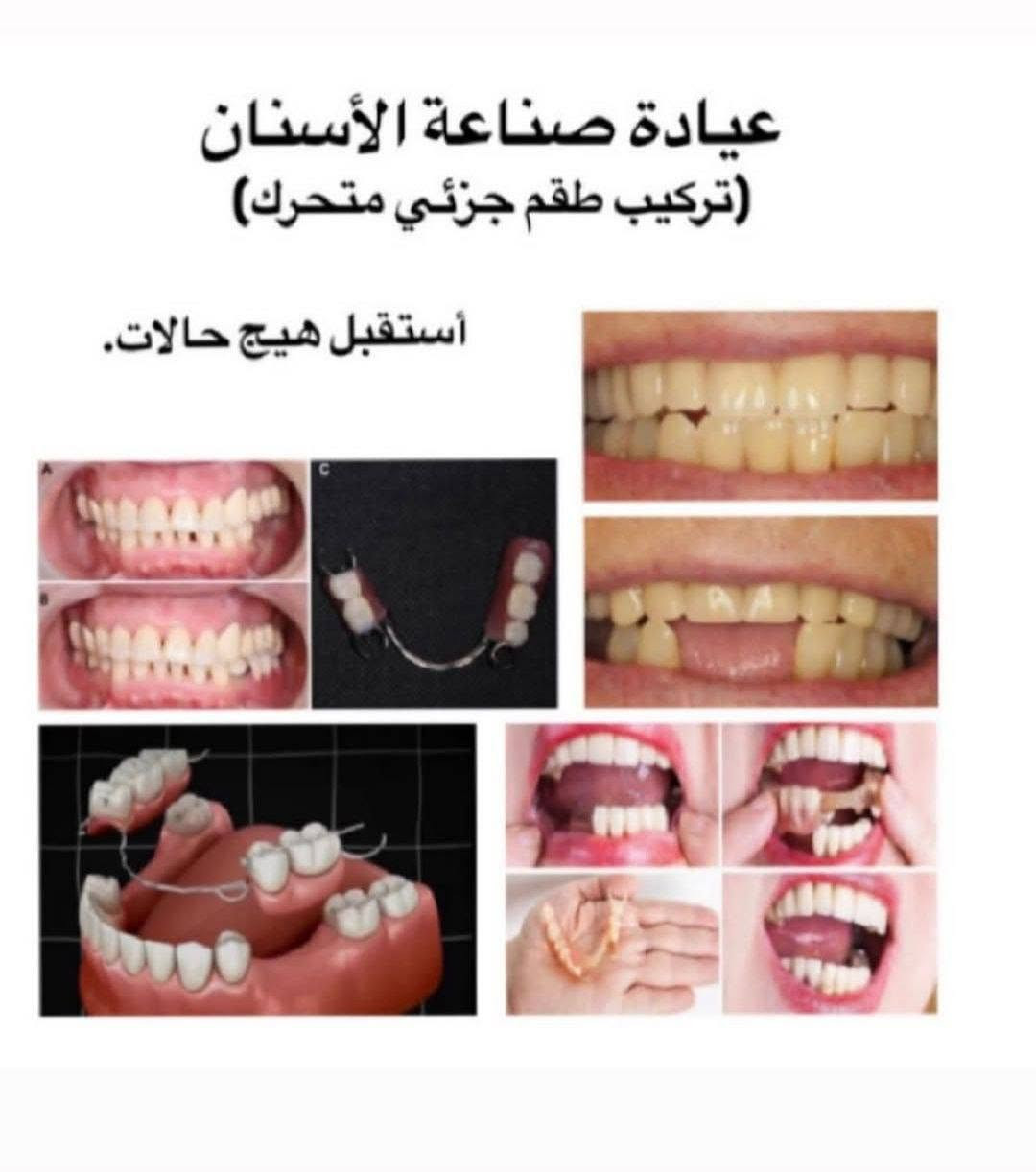 أكو إمكانية للعلاج مجاناً ضمن الحالات المتاحة.
الخدمات المتوفرة: 🦷 حشوات عادية
🦷 قلع الأسنان التالفة والجذور المتبقية
🦷 طقم أسنان جزئي
🦷 تنظيف وإزالة التكلسات
العلاج يتم  في عيادات الجامعةوتحت إشراف الكادر المختص.
📍 بغداد/ شارع فلسطين
📩 إذا حاب/ة تستفسر عن حالتك، راسلنا خاص 🤍
واللي يعرف شخص محتاج، خلي يدزله المنشور 🌷
 للمراسلة واتساب ***********

نص مكتوب في الصور:
- عيادة الحشوات الضوئية (التجميلية )
- أستقبل كل هاي الحالات من التسوس .
- فالي عنده هيج تسوس يتواصل ويانه لأستبدالها بحشوات ضوئية تجميلية ☺️👍
- عيادة الجراحة (القلع) أستقبل هيج حالات .. إذا عندك أسنان تالفة أو بقايا جذور، أو تعرف أحد من عائلتك أو أصدقائك يحتاج علاج، يتواصل ويانه ✨😊✨
- عيادة صناعة الأسنان (تركيب طقم جزئي متحرك) أستقبل هيك حالات.
- عيادة تنظيف الأسنان و أزالة التكلسات أستقبل هيج حالات. حته نحافظ ع نظافة وصحه أسنانكم