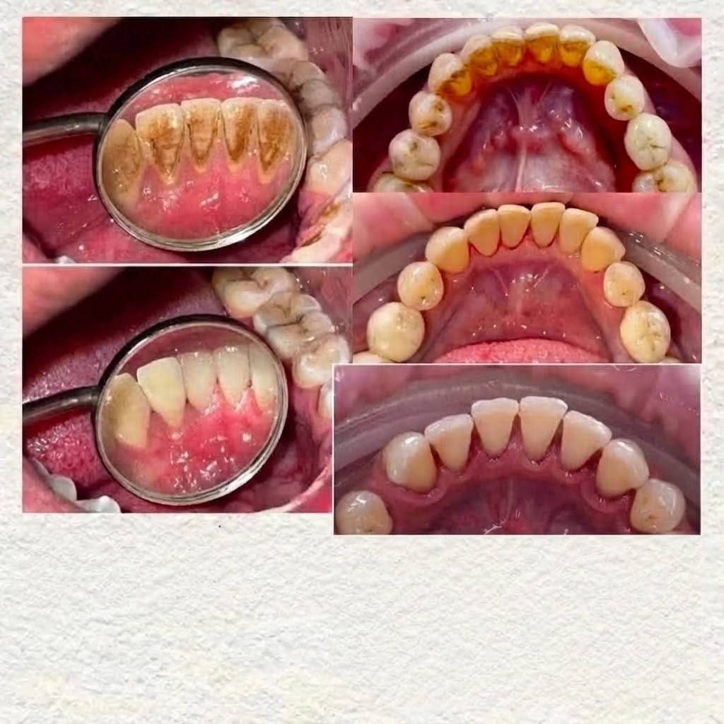 🦷✨ تم فتح باب الحجز لعلاج الأسنان المجاني ✨🦷
📍في عيادات جامعة أصول العلم 

الحالات المتوفرة 👇👇 
📍 حشوات ضوئية – قلع – تنظيف تكلسات  – طقم أسنان متحرك.

✅ كلشي متوفر وبالمجان وتحت إشراف أطباء اختصاص 

الموقع :- بغداد _ كلية أصول العلم _ باب المعظم _ قرب معهد الادارة

📞 للحجز والاستفسار
التواصل على الخاص أو واتساب: ***********
