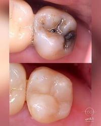 حشوة ضوئية • علاج مجاني • طب الاسنان